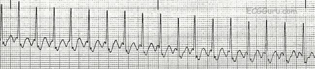 Ecg Basics Atrial Flutter With 2 1 Conduction Ratio